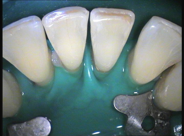 powierzchnia językowa zębów przygotowana do szynowania 